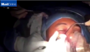 بالفيديو .. أطباء كولومبيون يزيلون ” قنبلة ” من رأس جندي