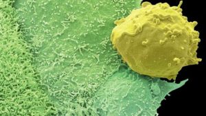 دراسة : شراسة سرطان الـ ” بروستاتا ” مرتبطة بحجم الخصر
