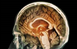 اكتشاف جسيمات ملوثة داخل أنسجة مخ الإنسان