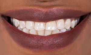 ” علاج جديد ” قد يضع حداً لعمليات حشو الأسنان
