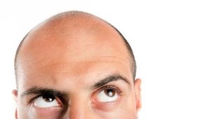 باحثون يكتشفون الخلايا التي تؤدي إلى فقدان الشعر