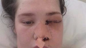 شابة أمريكية تخسر عينها بسبب ” خراج ” في ضرسها !