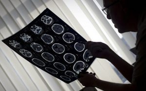 العلماء الروس يبتكرون رذاذاً خاصاً لاستئصال أورام الدماغ