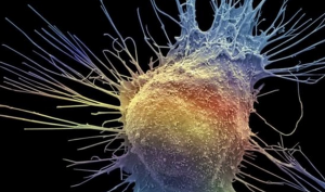 علاج جديد لـ ” سرطان البروستاتا ” يمكن أن يساعد المزيد من المرضى