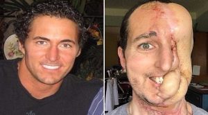 رجل أمريكي يفقد نصف وجهه نتيجة حالة مرضية نادرة