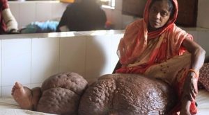 بسبب مرض نادر .. امرأة في بنغلادش يبلغ وزن ساقها فقط 60 كيلو غرام !