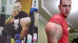 جندي روسي سابق يحقن نفسه بمادة خطيرة ليحصل على عضلات ” باباي ” ! (فيديو)