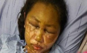 امرأة تايلندية تفقد بصرها بعد هجوم بالأسيد من حبيبها الغيور