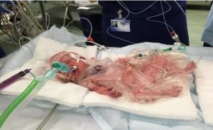 بريطانيا : جراحة نادرة لرضيعة ولدت بقلب خارج جسمها