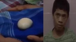 في أندونيسيا : طفل يبيض كالدجاج .. و الأطباء يشككون ! ( فيديو )