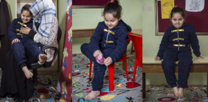 بعد سنوات من تعرضها لكيماوي بشار الأسد .. طفلة سورية تستعيد قدرتها على الوقوف و المشي في تركيا ( صور )