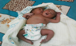 حالة نادرة .. ولادة طفل برأسين في السودان