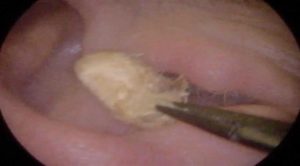 إزالة قطنة تنظيف علقت في أذن مريض بريطاني لعامين ! ( فيديو )