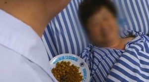 استخراج مئات الحصى من مرارة امرأة صينية شغوفة بتناول الأطعمة المقلية