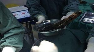 الصين : أطباء يخرجون ثمرة باذنجان ضخمة من أمعاء رجل !