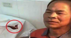استخراج علقة عاشت أسبوعين في أنف رجل صيني ! ( فيديو )