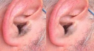 دراسة : كثافة شعر الأذن قد تكون مؤشراً على مرض قاتل