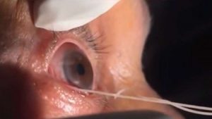 استخراج دودة بطول 15 سنتيمتراً من ” عين ” مسن هندي ( فيديو )