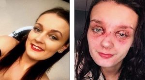 شابة بريطانية تفقد البصر في أحد عينيها بسبب ” بيضة “