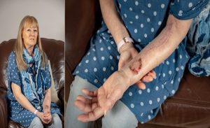 بعد معركة مع مرض السرطان .. امرأة بريطانية تحصل على لسان من ذراعها