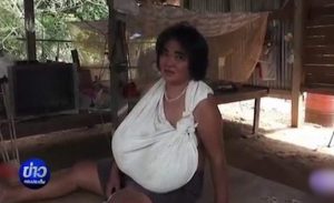 نمو غير طبيعي لثديي امرأة تايلندية بسبب مرض غامض
