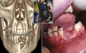 سيجارة إلكترونية تنفجر في فم مراهق و تسبب له إصابات مرعبة