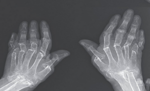 حالة طبية نادرة تسبب ” اختفاء ” عظام أصابع امرأة تركية