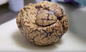 اكتشاف دماغ غامض في جمجمة مقتول